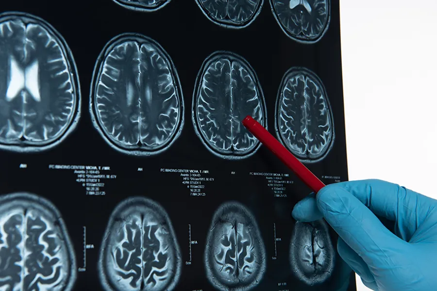 Kroppsmasseindeks målt over 42 år og risiko for hjerneinfarkt i HUNT studien 
